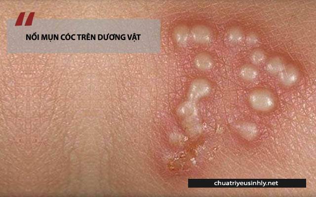 biểu hiện ung thư dương vật