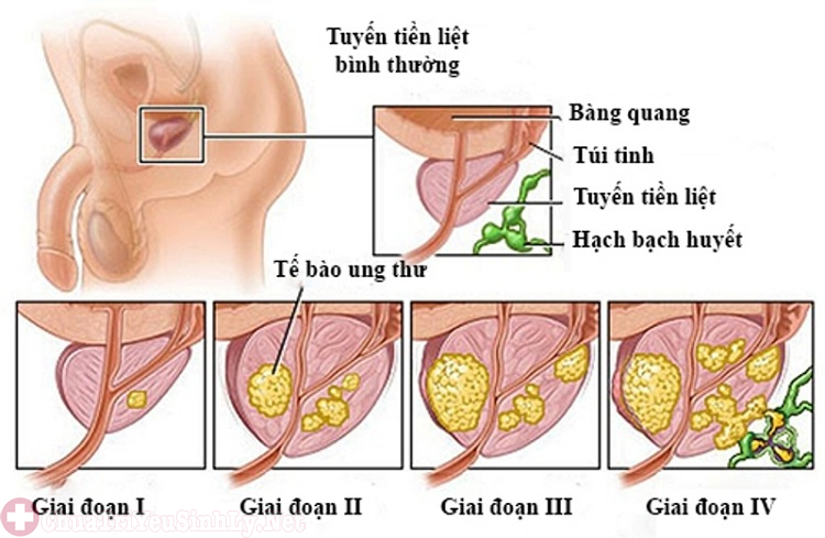 Ảnh hưởng đến sức khỏe của người bệnh