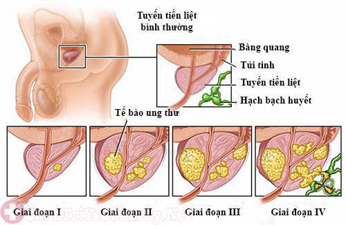 Siêu âm tuyến tiền liệt ở bệnh viện Việt Đức Hà Nội