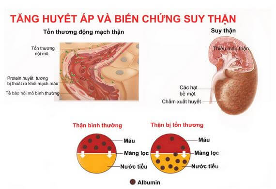 Thận yếu gây tăng huyết áp và biến chứng suy thận