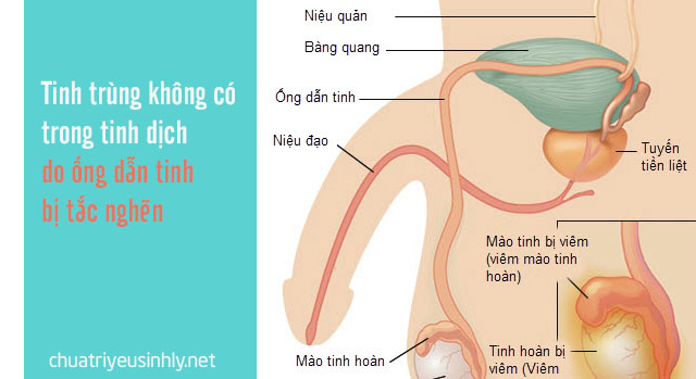 Ống dẫn tinh bị tắc nghẽn là nguyên nhân không có tinh trùng ở nam giới