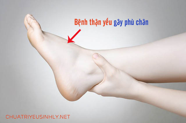 Phù chân là tác hại của bệnh thận yếu