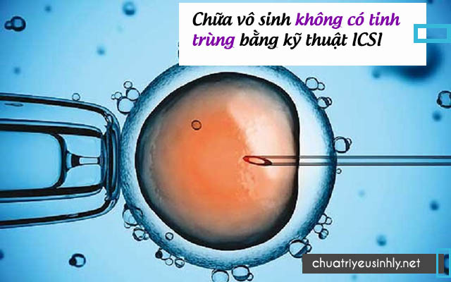 Kỹ thuật icsi chữa vô sinh không tinh trùng